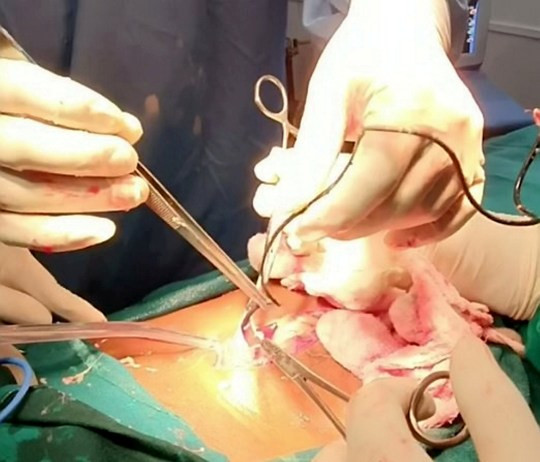 Doctor Removed Phone Charger From Man’s Bladder