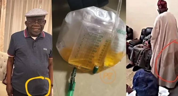#Tinubu Allegedly Wears Catheter Bag For Urine
